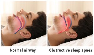 Comparison of normal airway and obstructive sleep apnea