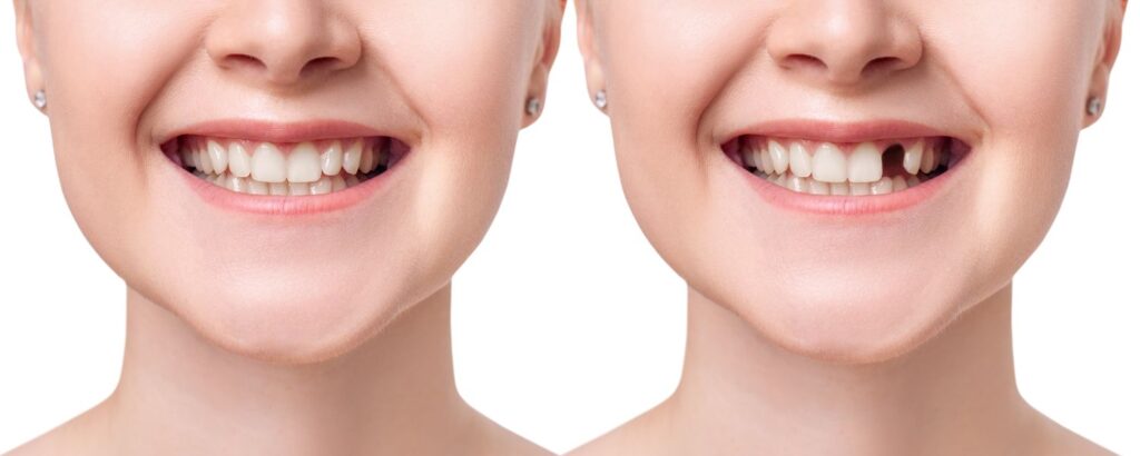A woman’s mouth with a front dental implant